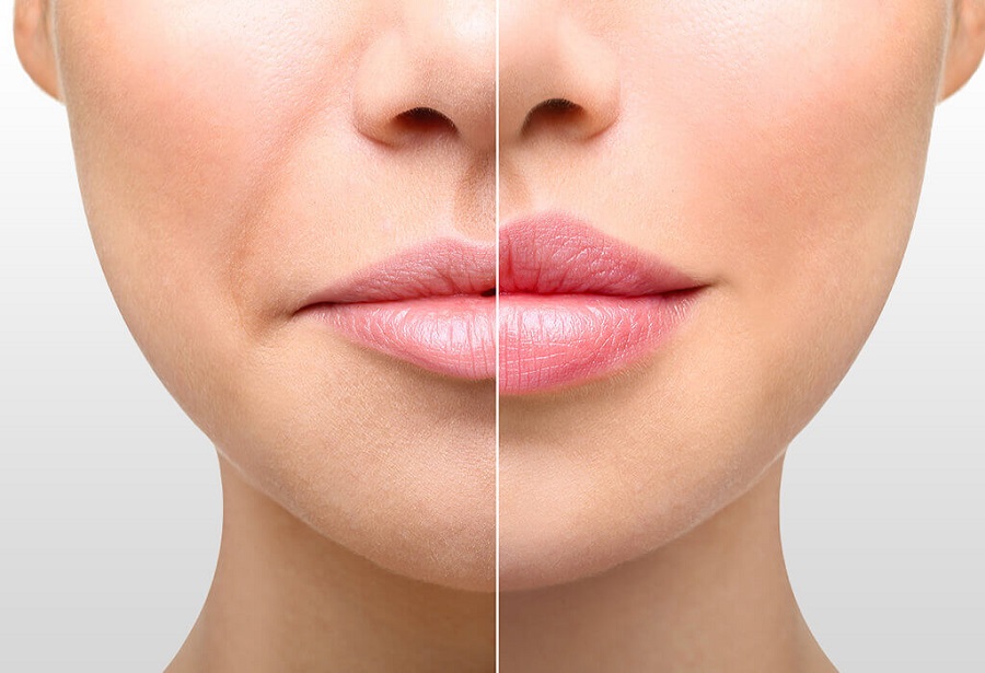 как убрать носогубные морщины